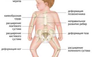 О рахите расскажу