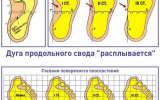 Плоскостопие у детей: симптомы и лечение