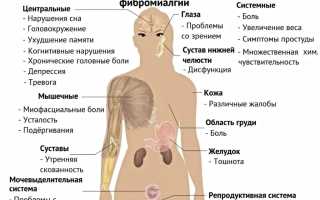 Как лечить синдром фибромиалгии