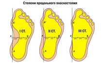 Как развить плоскостопие 3 степени