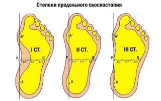 Как развить плоскостопие 3 степени