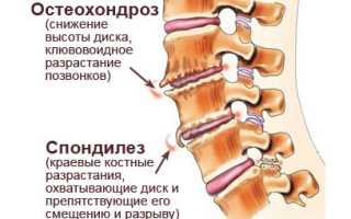 Что такое деформирующий спондилез: причины и признаки заболевания