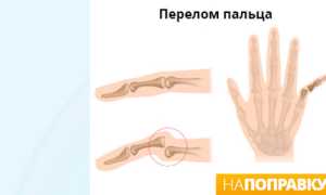 Симптомы перелома пальца руки, оказание первой помощи и лечение