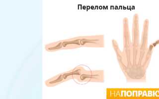 Симптомы перелома пальца руки, оказание первой помощи и лечение
