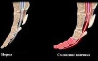 Почему смещаются сегменты копчика и как это исправить?