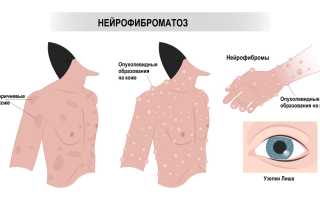 Нейрофиброматоз реклингхаузена: симптомы, диагностика и лечение