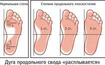 Берут ли в армию с плоскостопием