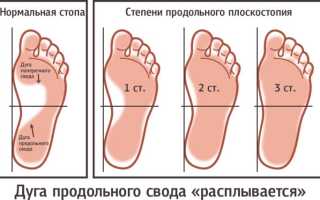 Берут ли в армию с плоскостопием