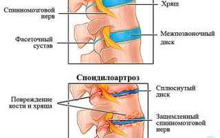 Дегенеративно-дистрофические изменения в пояснично-крестцовом отделе