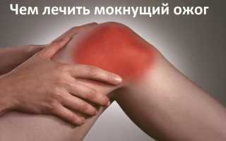 Мокнет рана в последствии ожога