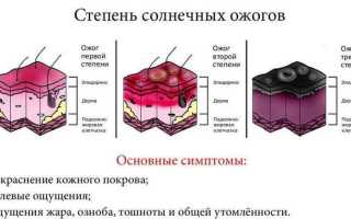 Как справиться с ожогами кожи вызванными солнцем