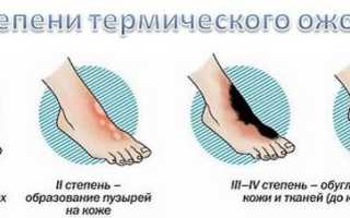 Признаки термического ожога, как оказать первую помощь
