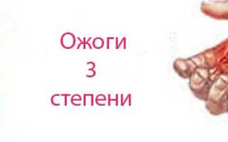 Ожоги третьей степени: как оказать помощь
