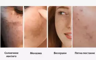 Что такое пигментация ?