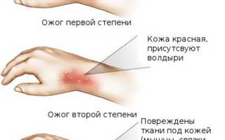 Первая помощь при ожоге кипятком. Что делать?