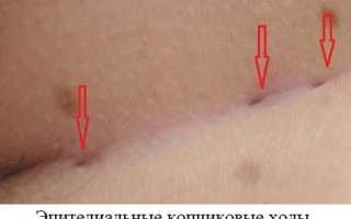 Эпителиальный копчиковый ход