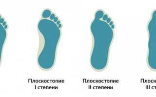 К какому врачу обращаться с плоскостопием?