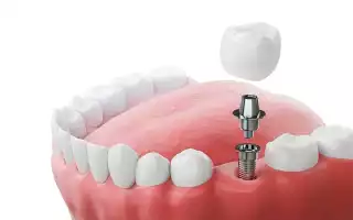 Что такое зубные имплантаты? Сколько стоит один зубной имплант?