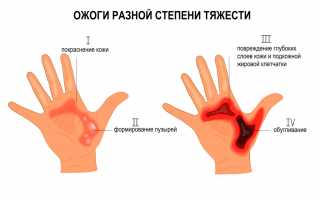 Узнайте все об ожогах: различные стадии и способы их лечения