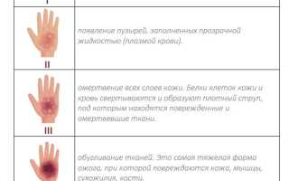Ожоги на рабочем месте: Стандарты безопасности и охрана труда