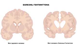 Болезнь гентингтона