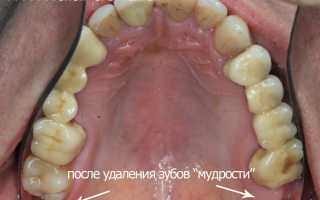 Удаление зуба мудрости