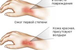 Ожоги второй степени: как оказать помощь