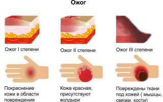 Химический ожог: первая помощь, уход за раной