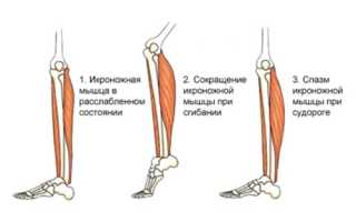 Мышечный спазм в икроножной мышце