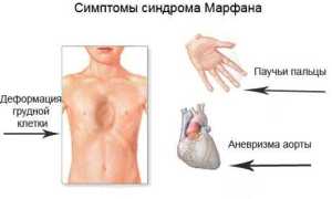 Синдром марфана: фото, симптомы и лечение