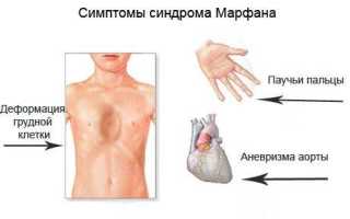 Синдром марфана: фото, симптомы и лечение