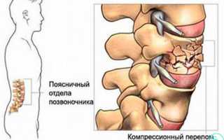 Перелом 12 позвонка поясничного отдела лечение