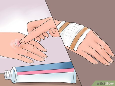 Изображение с названием Treat a Burn Step 11