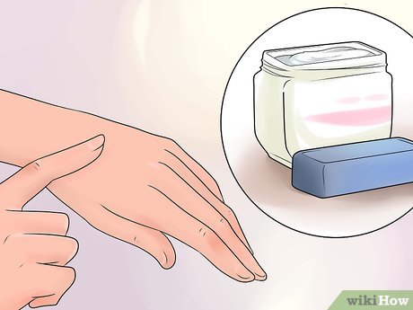 Изображение с названием Treat a Burn Step 14