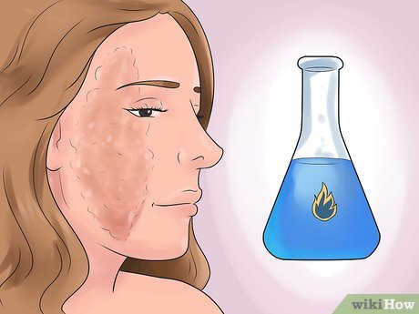 Изображение с названием Treat a Burn Step 5